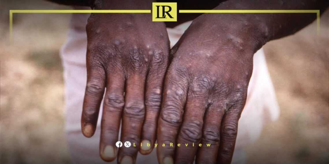 Monkeypox Threatens Libya’s Health System as Migrant Numbers Soar