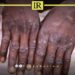 Monkeypox Threatens Libya’s Health System as Migrant Numbers Soar